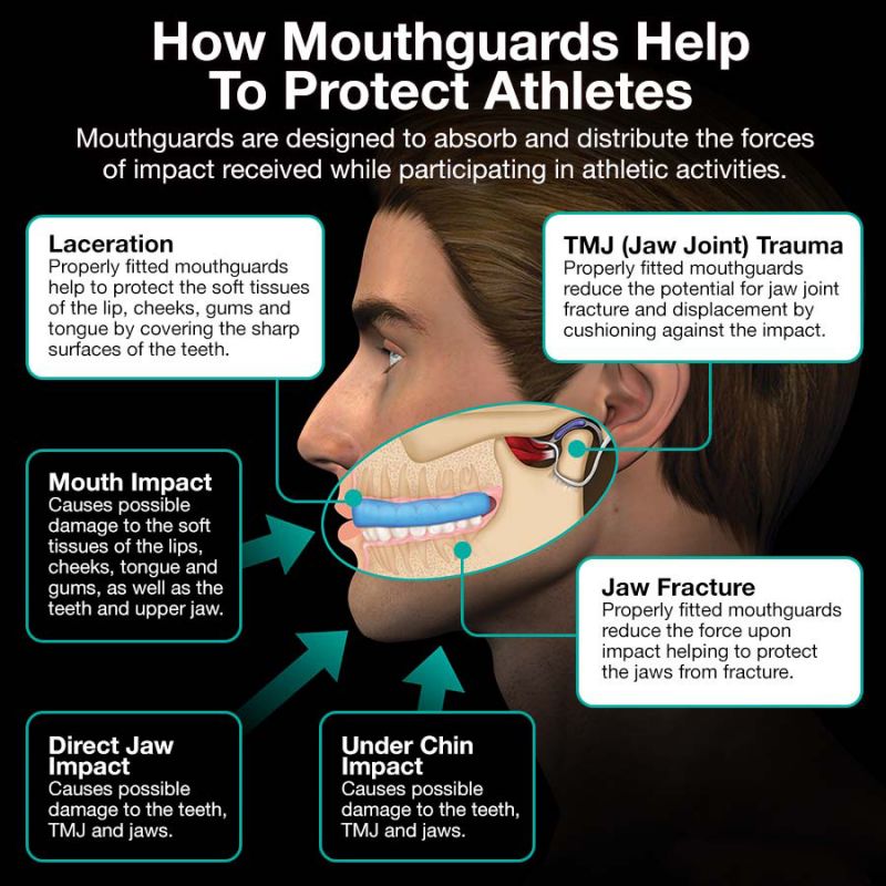 Adult Mouthguards The Ultimate Guide to Choosing and Using