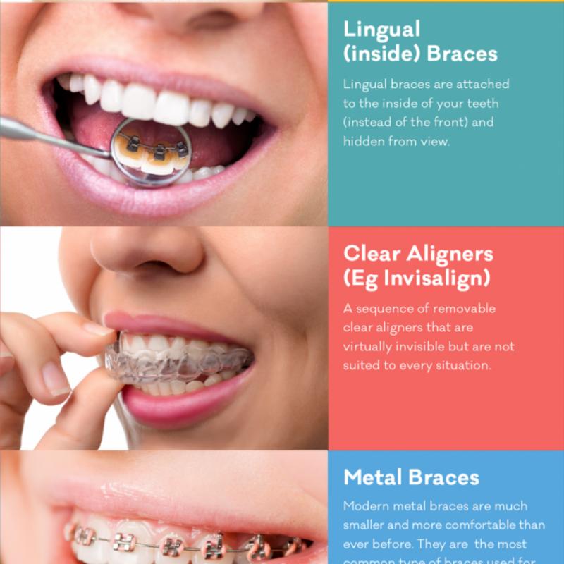 Are Clear Aligners Right for You This Year: Answers to Top Questions About Invisible Orthodontics