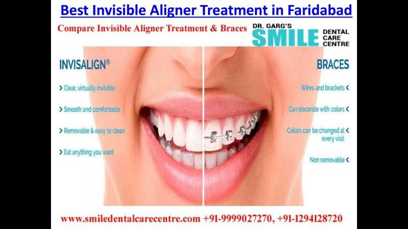 Are Clear Aligners Right for You This Year: Answers to Top Questions About Invisible Orthodontics
