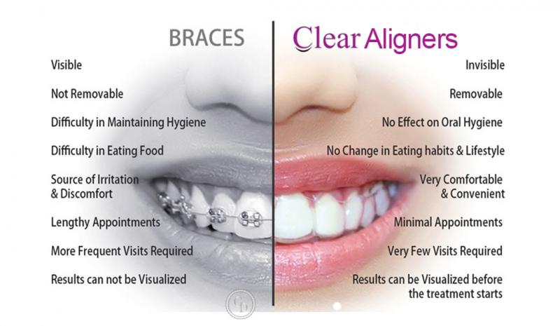 Are Clear Aligners Right for You This Year: Answers to Top Questions About Invisible Orthodontics