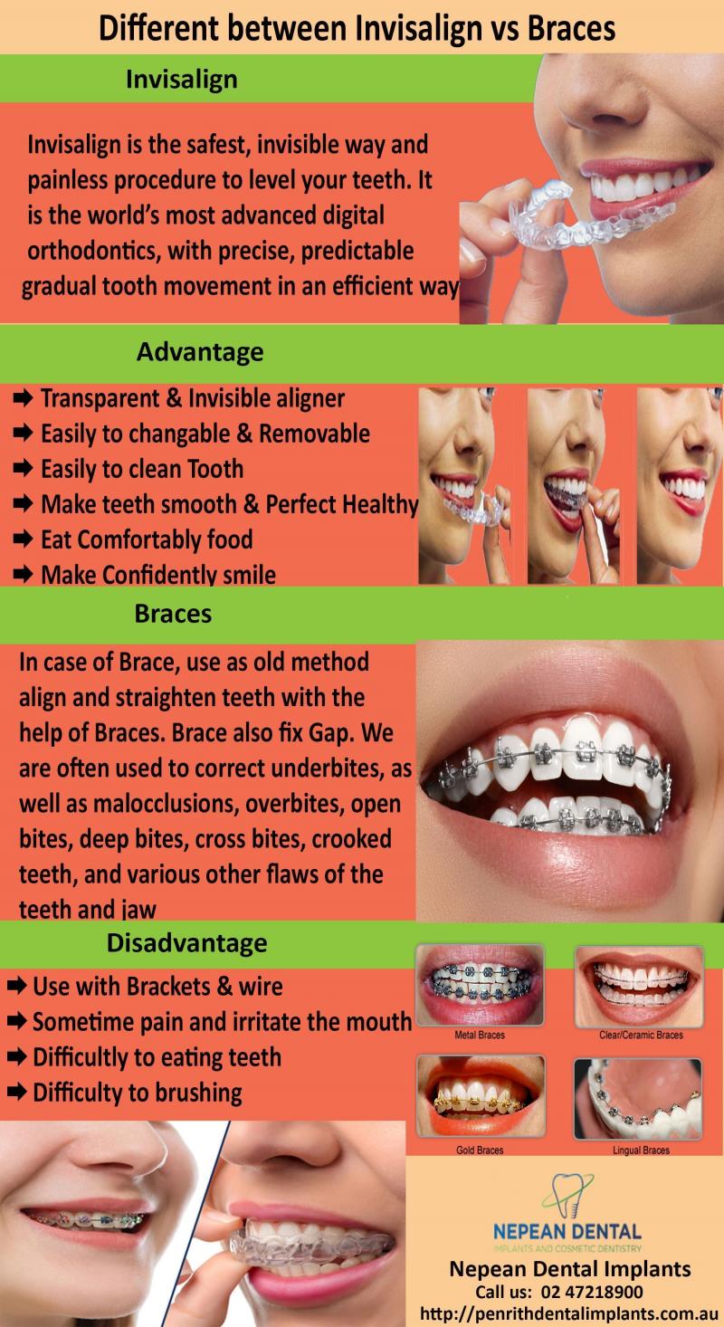 Are Clear Aligners Right for You This Year: Answers to Top Questions About Invisible Orthodontics