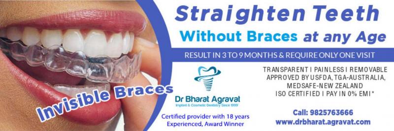 Are Clear Aligners Right for You This Year: Answers to Top Questions About Invisible Orthodontics