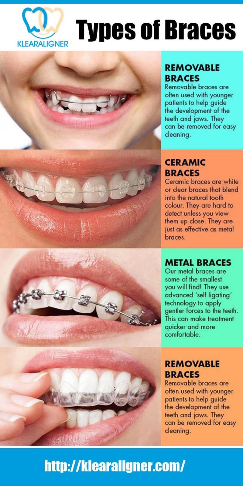 Are Clear Aligners Right for You This Year: Answers to Top Questions About Invisible Orthodontics