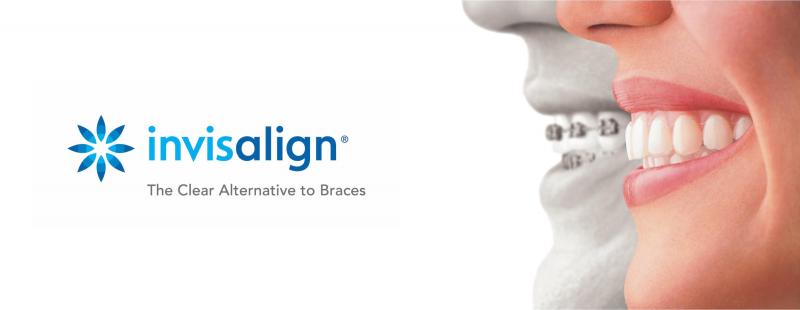 Are Clear Aligners Right for You This Year: Answers to Top Questions About Invisible Orthodontics