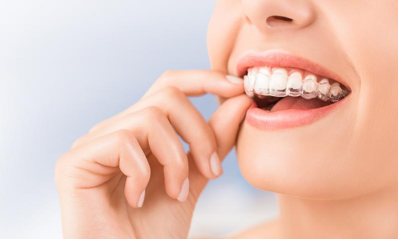 Are Clear Aligners Right for You This Year: Answers to Top Questions About Invisible Orthodontics