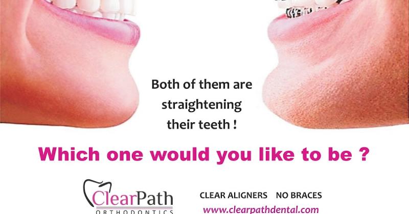 Are Clear Aligners Right for You This Year: Answers to Top Questions About Invisible Orthodontics