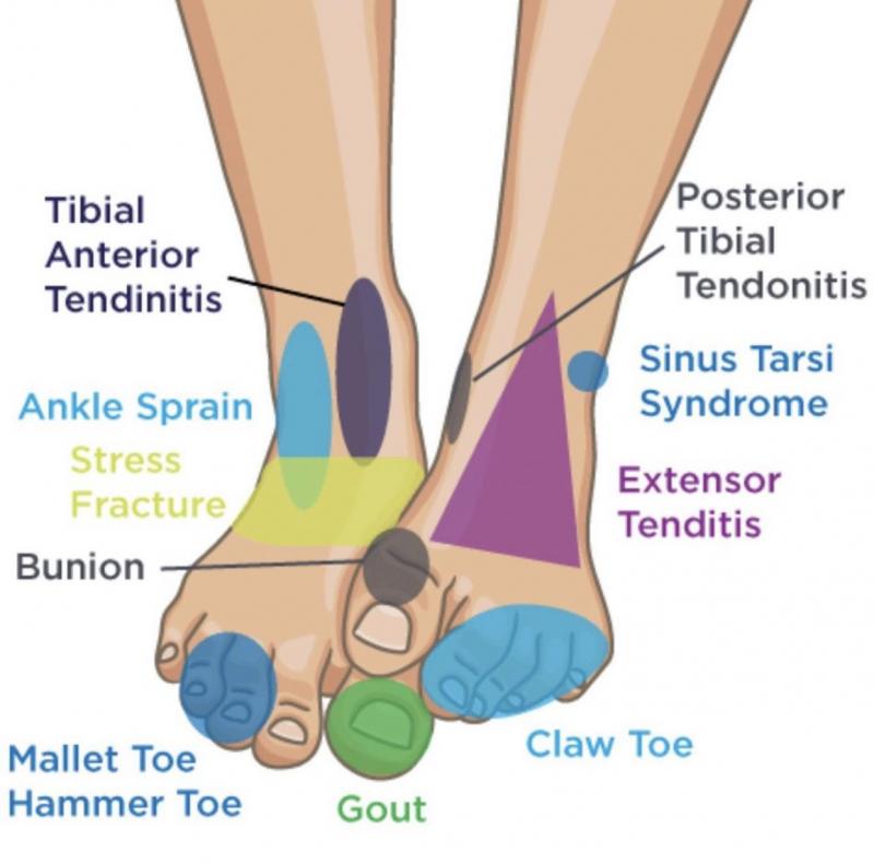 Are You Dealing With Ankle Pain. Improve Ankle Stability & Support With This Brace