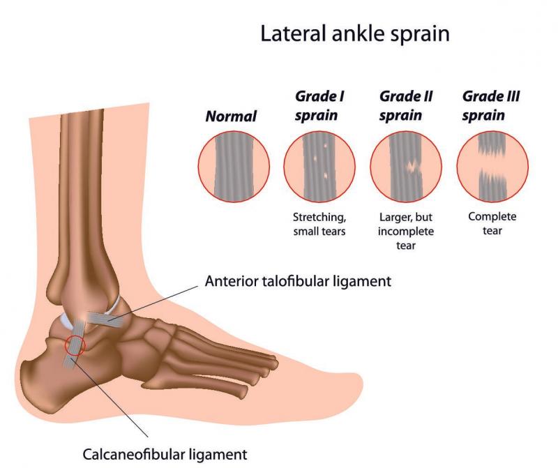 Are You Dealing With Ankle Pain. Improve Ankle Stability & Support With This Brace