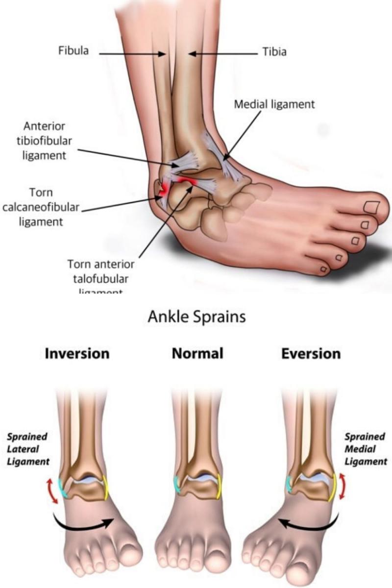 Are You Dealing With Ankle Pain. Improve Ankle Stability & Support With This Brace