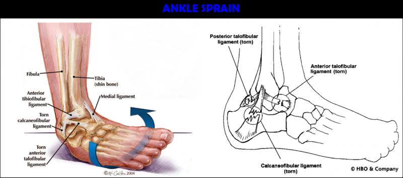 Are You Dealing With Ankle Pain. Improve Ankle Stability & Support With This Brace