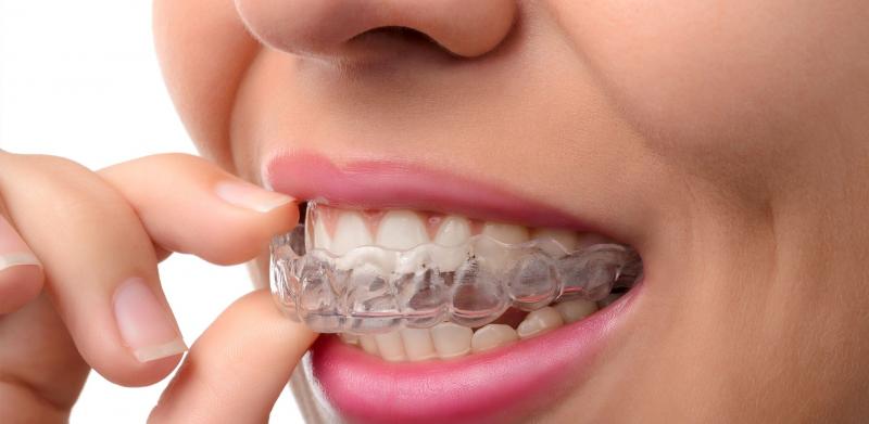 Best Lacrosse Mouthguards for Braces in 2023: How to Keep Your Smile Safe on the Field
