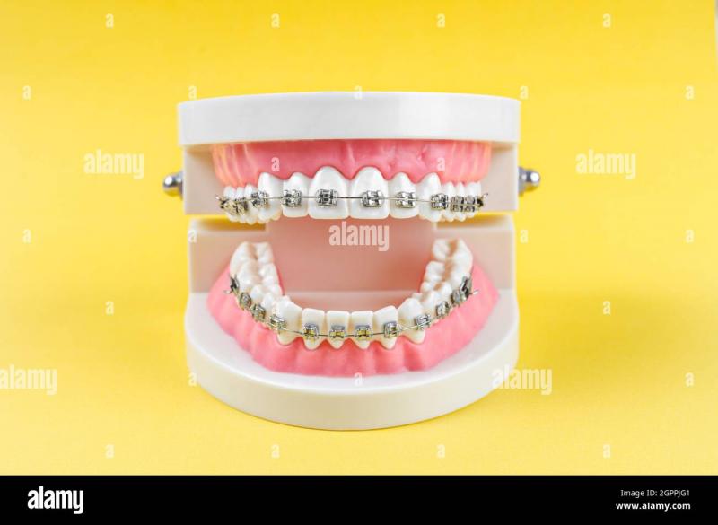 Best Lacrosse Mouthguards for Braces in 2023: How to Keep Your Smile Safe on the Field