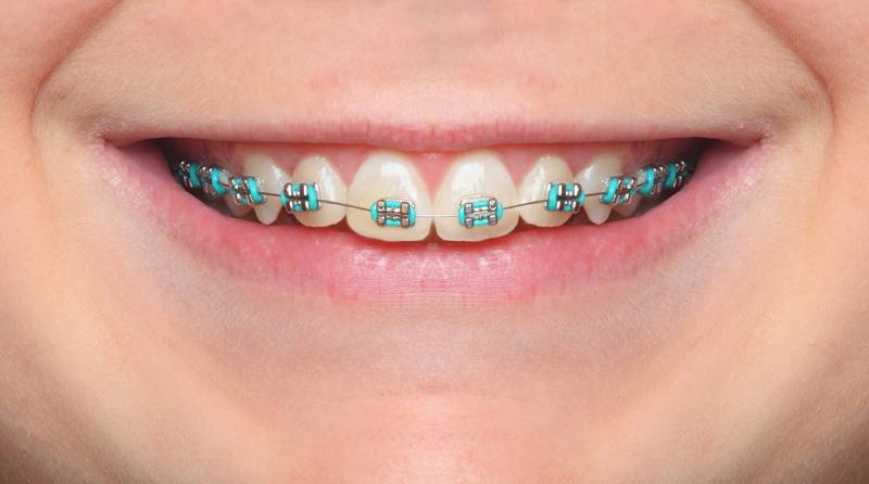 Best Lacrosse Mouthguards for Braces in 2023: How to Keep Your Smile Safe on the Field