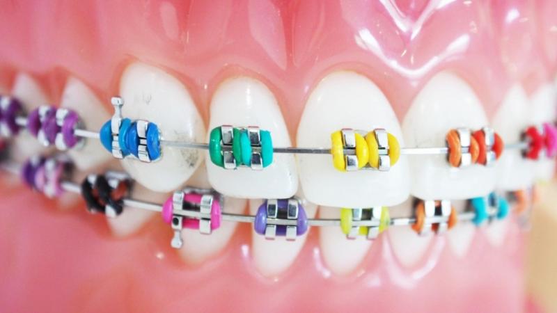 Best Lacrosse Mouthguards for Braces in 2023: How to Keep Your Smile Safe on the Field