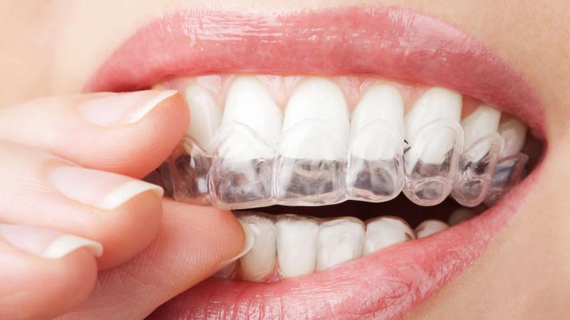 Best Lacrosse Mouthguards for Braces in 2023: How to Keep Your Smile Safe on the Field