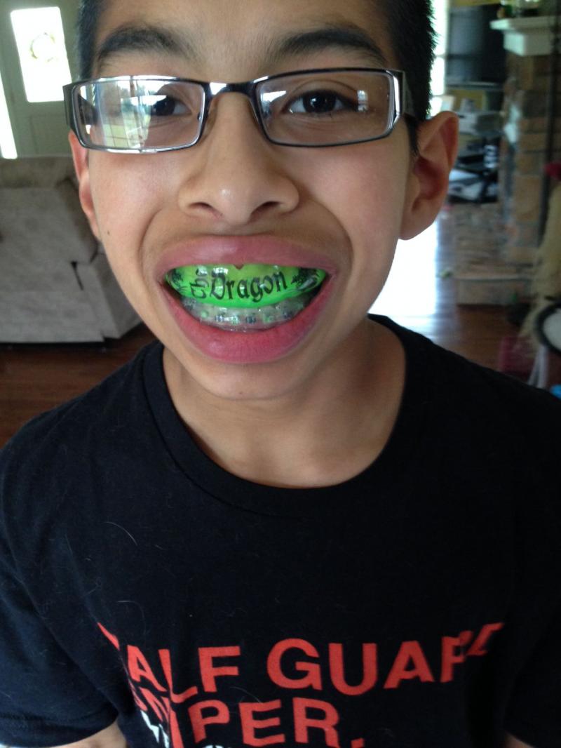 Braces Mouthguards With Straps: 15 Shocking Facts You Must Know in 2023