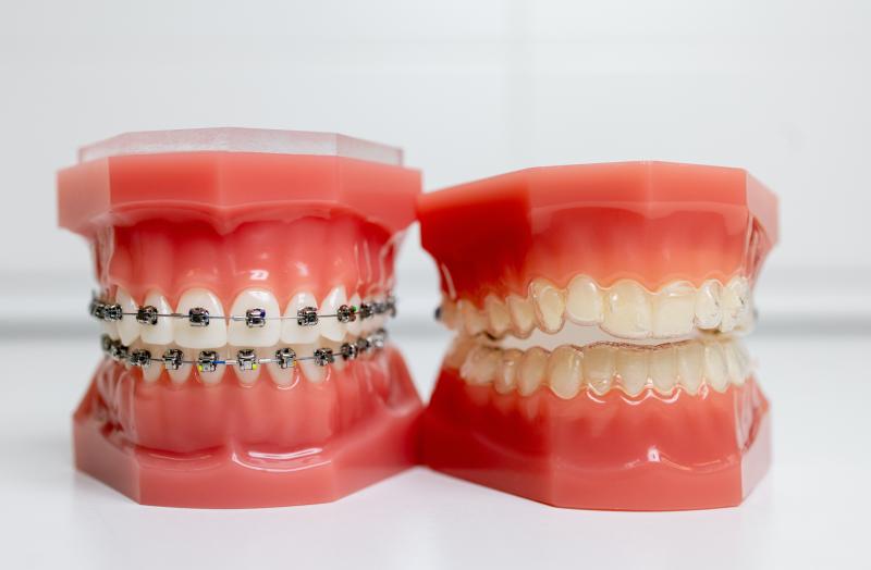 Braces Mouthguards With Straps: 15 Shocking Facts You Must Know in 2023