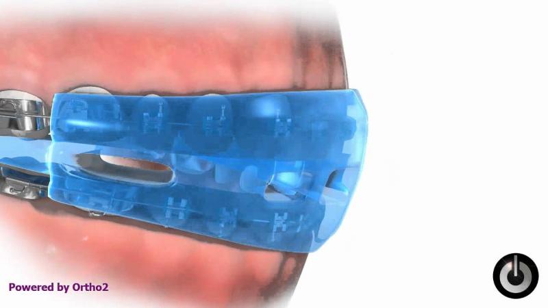 Braces Mouthguards With Straps: 15 Shocking Facts You Must Know in 2023