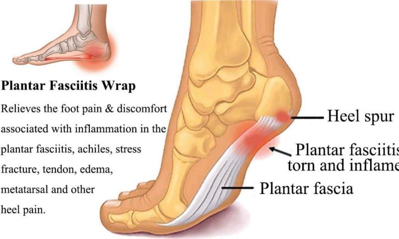 Can a Plantar Fasciitis Sleeve Relieve Your Foot Pain. McDavid Offers Solutions