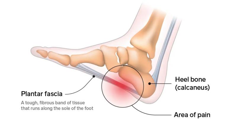 Can a Plantar Fasciitis Sleeve Relieve Your Foot Pain. McDavid Offers Solutions