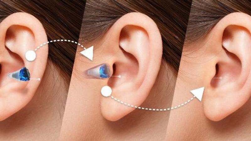 Can Hearing Aids Really Help the Profoundly Deaf: Discover How New Technology is Transforming Lives