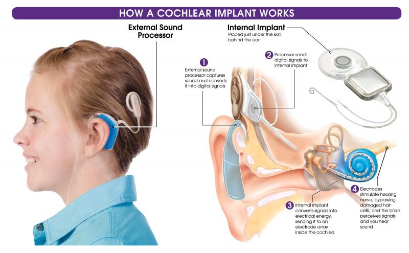 Can Hearing Aids Really Help the Profoundly Deaf: Discover How New Technology is Transforming Lives