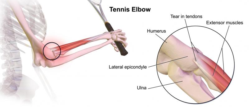 Chilled to the Bone. Try These Innovations to Cure Painful Elbows