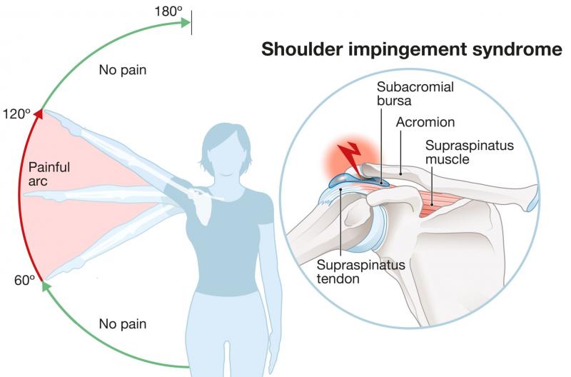 Chilled to the Bone. Try These Innovations to Cure Painful Elbows