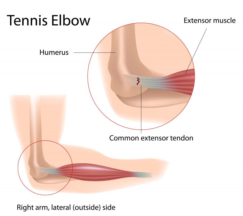 Chilled to the Bone. Try These Innovations to Cure Painful Elbows