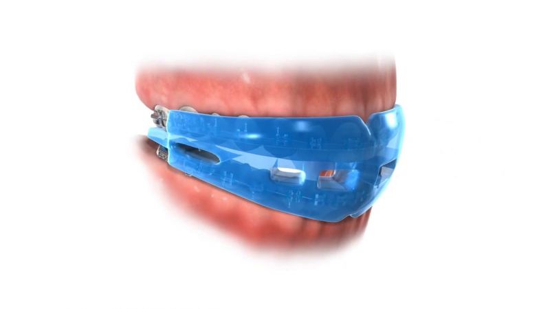 Choose the Best Mouthguard for Braces While Playing Sports
