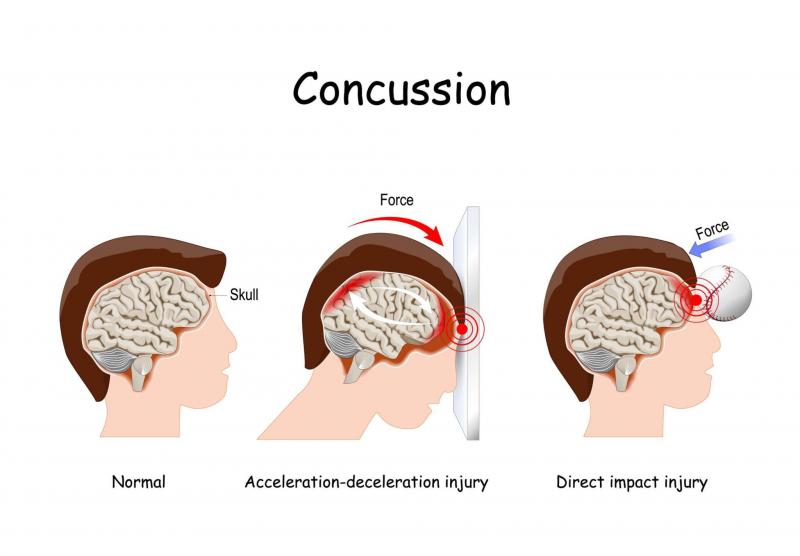 Could Lacrosse Cause Concussions. The Shocking Truth About Brain Injuries in Sports