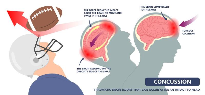 Could Lacrosse Cause Concussions. The Shocking Truth About Brain Injuries in Sports