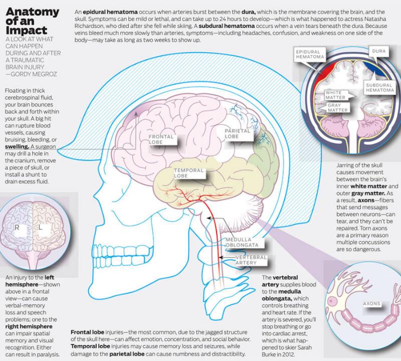 Could Lacrosse Cause Concussions. The Shocking Truth About Brain Injuries in Sports