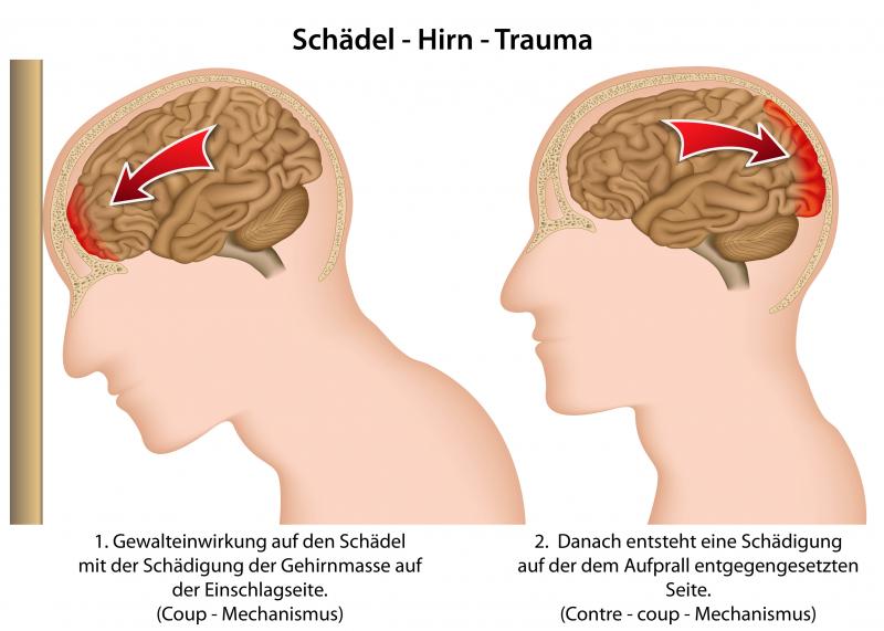 Could Lacrosse Cause Concussions. The Shocking Truth About Brain Injuries in Sports