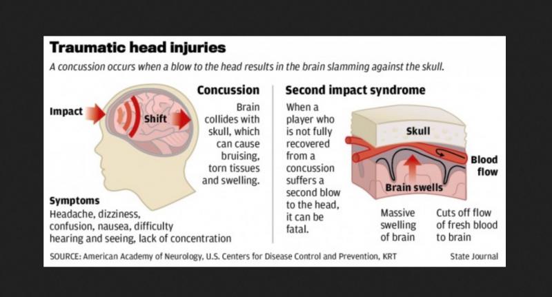 Could This Futuristic Neck Collar Prevent Concussions in Athletes