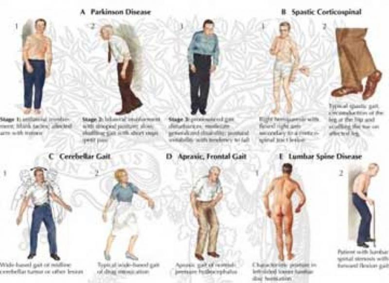 Could This Simple Device Improve Your Balance and Walking. The "Gait Draw" Explained
