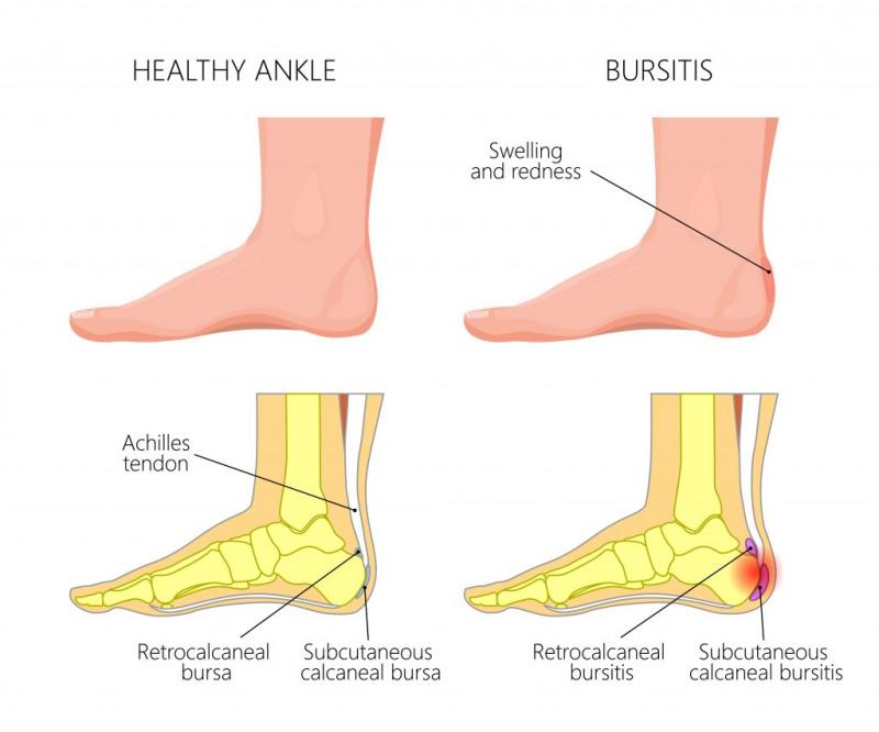Do You Suffer From Achilles Tendon Pain. Check Out These Top Copper-Infused Ankle Supports