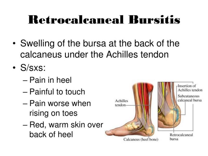 Do You Suffer From Achilles Tendon Pain. Check Out These Top Copper-Infused Ankle Supports