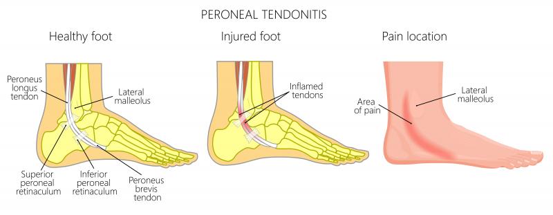 Do You Suffer From Achilles Tendon Pain. Check Out These Top Copper-Infused Ankle Supports