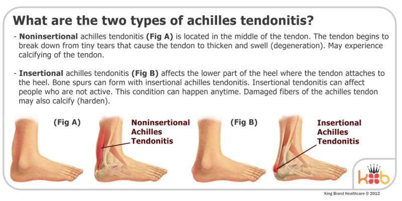 Do You Suffer From Achilles Tendon Pain. Check Out These Top Copper-Infused Ankle Supports
