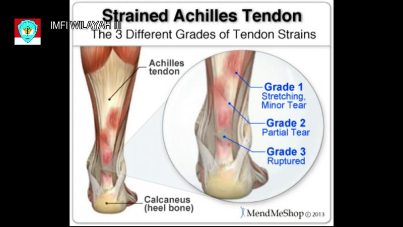 Do You Suffer From Achilles Tendon Pain. Check Out These Top Copper-Infused Ankle Supports