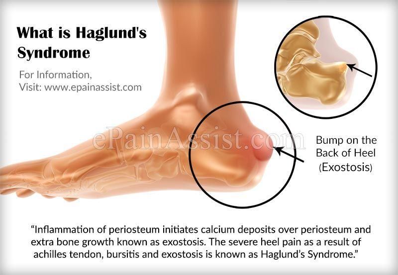 Do You Suffer From Achilles Tendon Pain. Check Out These Top Copper-Infused Ankle Supports
