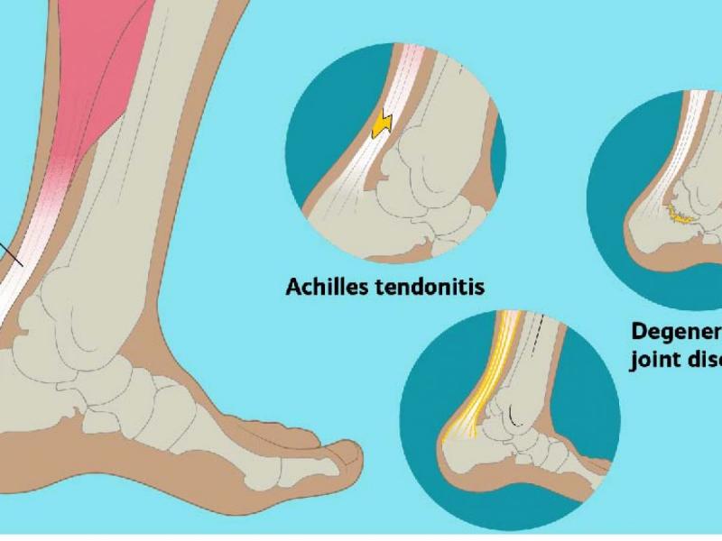 Do You Suffer From Achilles Tendon Pain. Check Out These Top Copper-Infused Ankle Supports