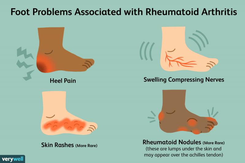 Engaging Interrogatory with Colon: Are These 7 Sof Sole Insoles the Best for Plantar Fasciitis Relief This Year. This Review Has the Fascinating Answer