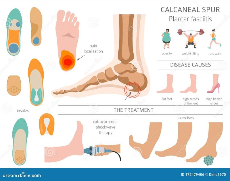 Engaging Interrogatory with Colon: Are These 7 Sof Sole Insoles the Best for Plantar Fasciitis Relief This Year. This Review Has the Fascinating Answer