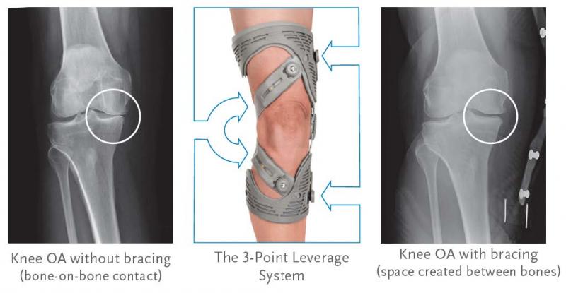 Feel Stable After Knee Injury. Try These Braces