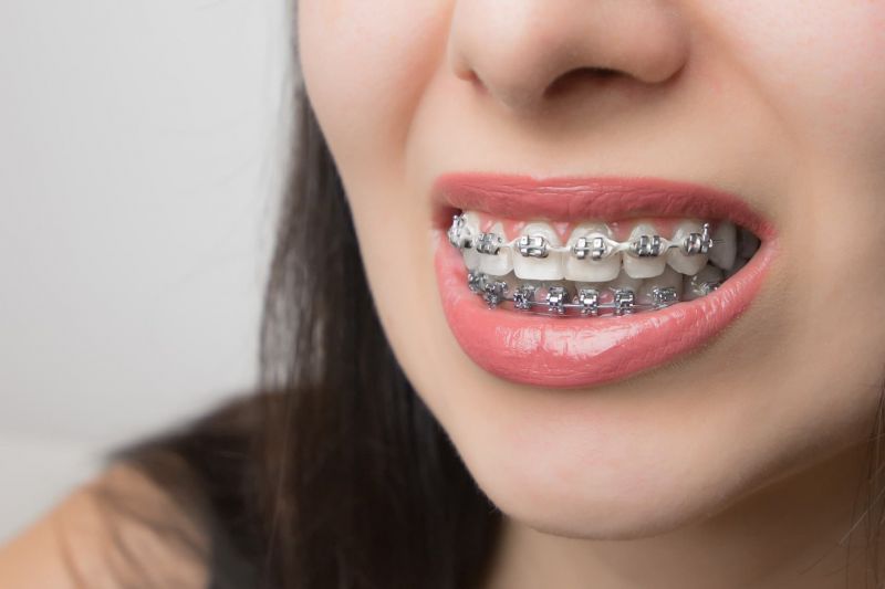 Get Straight Teeth With Double Braces Mouth Guards