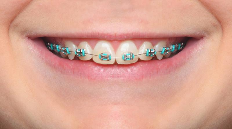 How to Choose the Best Mouthguard for Braces This Year