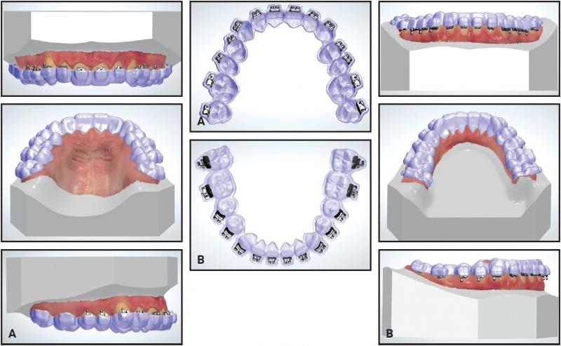 How to Choose the Best Mouthguard for Braces This Year