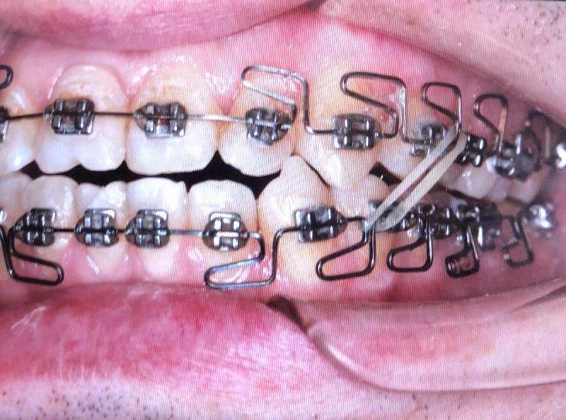 Looking for Orthodontic Care in Lakewood Ranch or Sarasota. 15 Must-Know Tips for Finding the Best Orthodontist